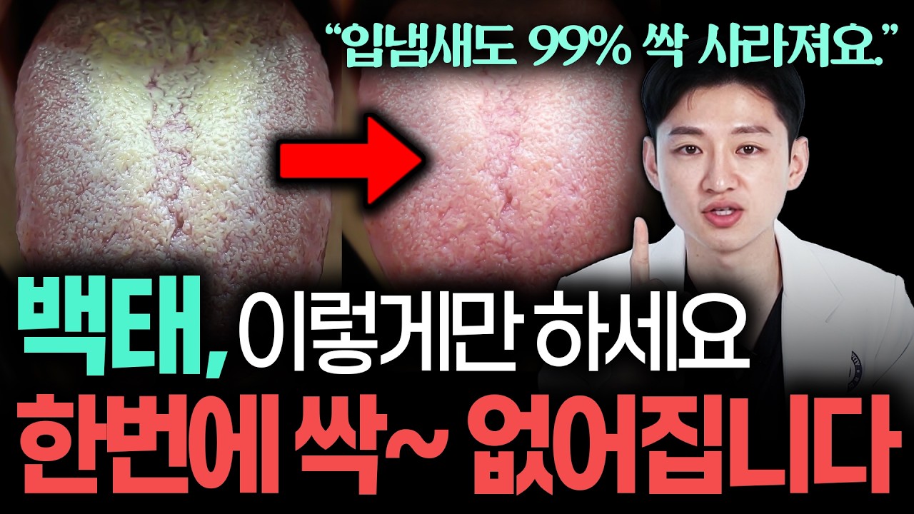 대부분 모르는 혀에 백태가 생기는 원인 | 혀 백태 한번에 없애는 방법! | (모르면 인생 손해;;)