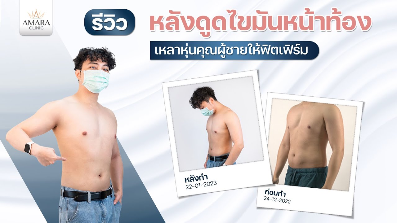 รีวิวหลังดูดไขมันหน้าท้อง ผู้ชายก็ดูดไขมันได้! L #เอมาร่าคลินิก  #Amaraclinic - Youtube