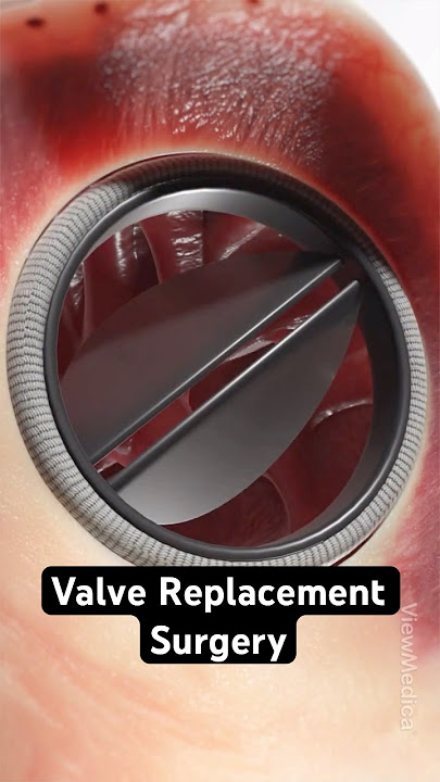 How surgeons replace a heart valve (3D Animation)