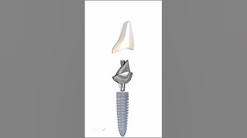 Ceramic Crown & Implant Abutment Anatomy