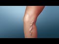 Treatment for Varicose Veins | Nucleus Health