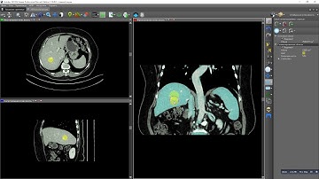 Segmentation using level set region growing