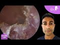1280  most complex case rare canal cholesteatoma removal