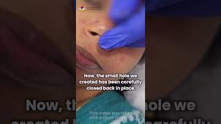 Nose piercing is safe—only if done in the right spot. | Dr S Murugusundram