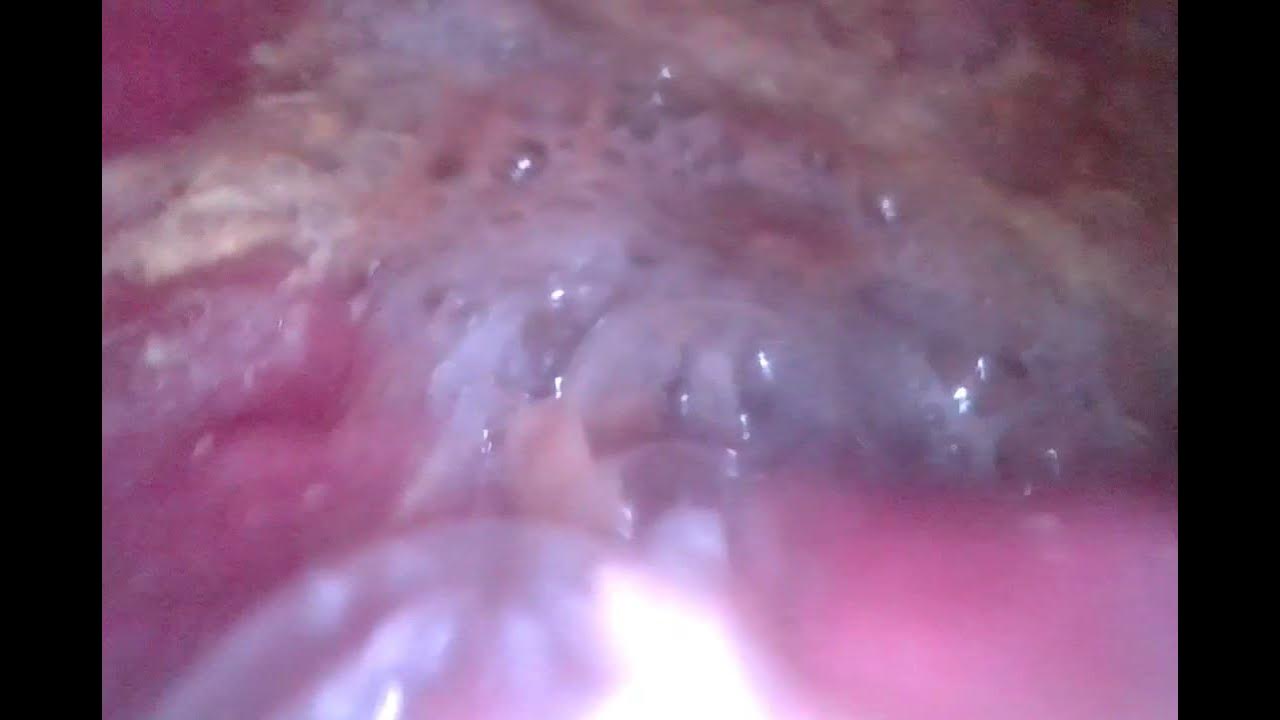 STOMACH CAM second try YouTube