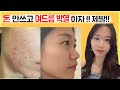 10년된 여드름 딱 3가지 방법으로 극복!! 집에서 이것만 하자!!(더이상 큰 돈 쓰지 말아요!) My journey to get rid of acne!