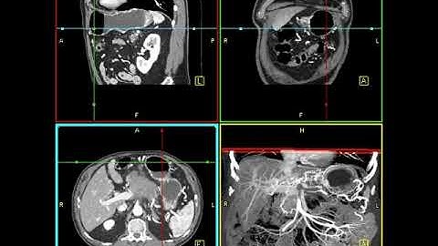 Abdomen: Pancreas: Pancreatic cancer : 3D mapping using volume rendering and MIP(2 of 2)