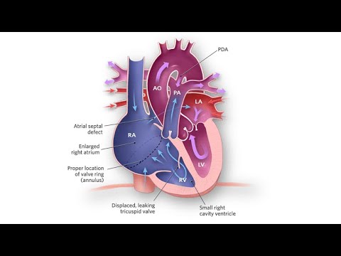 Vidéo: Malformation Cardiaque Congénitale (anomalie D'Ebstein) Chez Le Chat