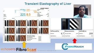 Interpreting Fibro Scan Result