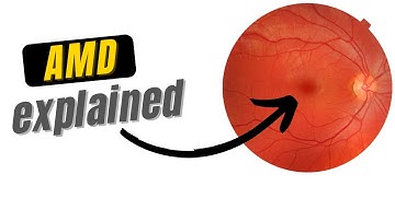 What is Macular Degeneration?