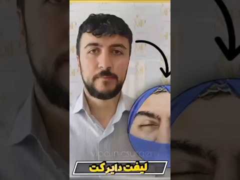 مراحل لیفت دایرکت ابرو