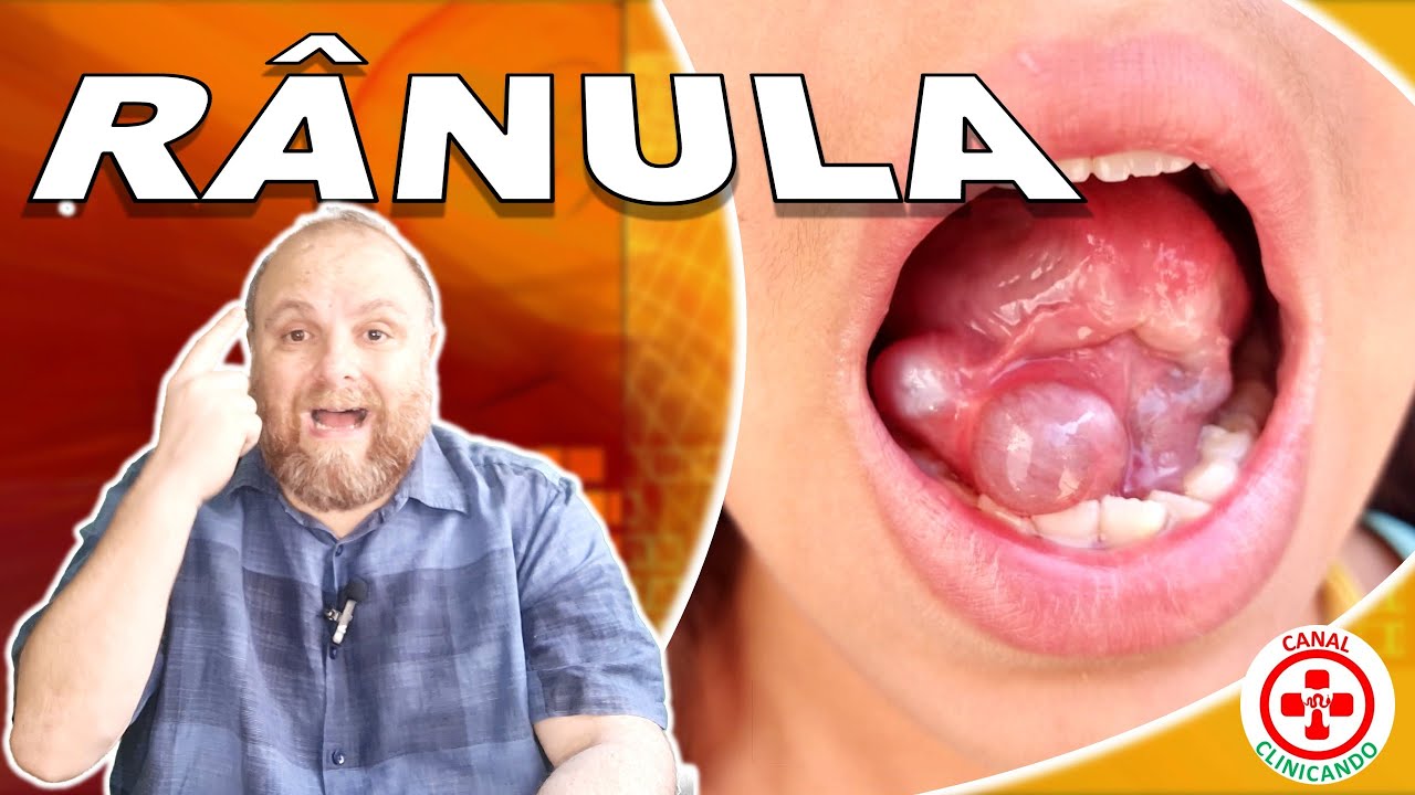 Marsupialization Small Ranula Rânula - Marsupialização - YouTube