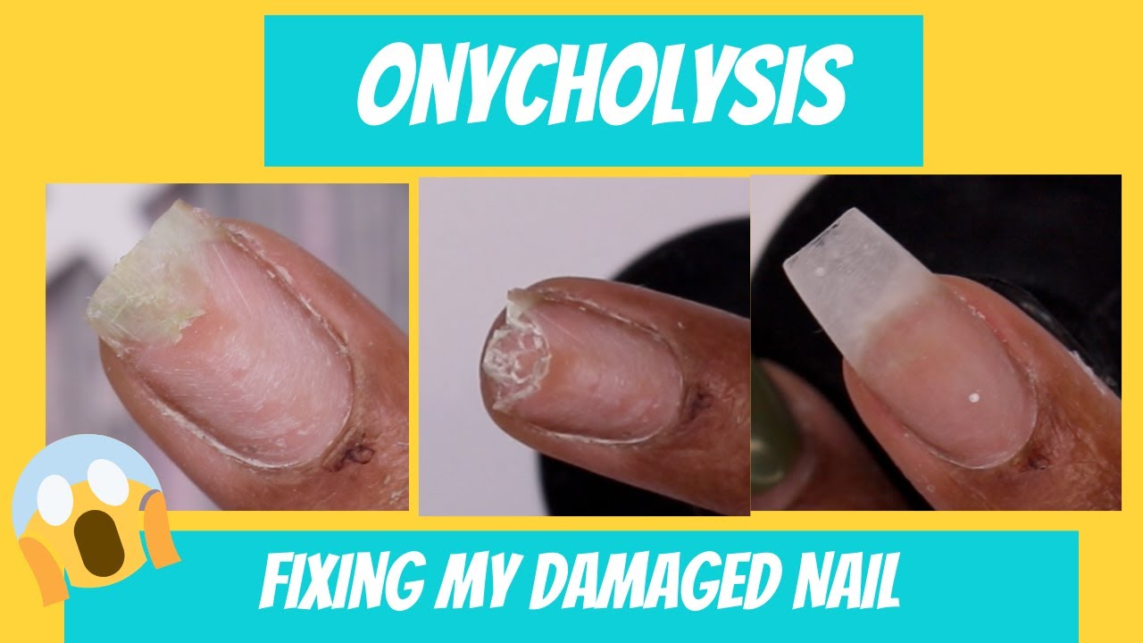 2 Nail bed psoriasis, features of onycholysis, and oil drop discoloration |  Download Scientific Diagram