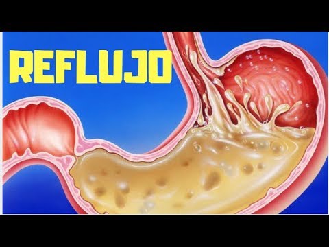 algo natural para el reflujo gastrico