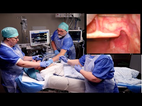 Video: Hvordan laver man en intubationsproces?