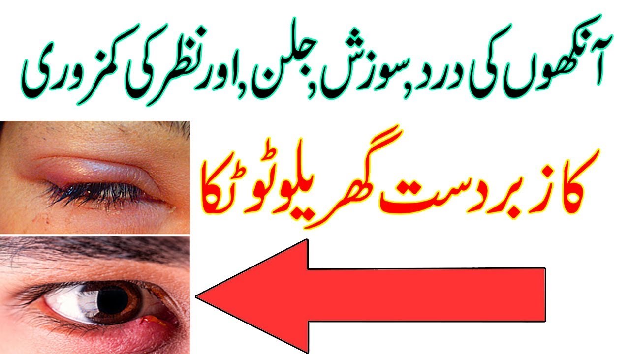 Ankhon Ke Dard Ka Ilaj How To Cure Eye Infection YouTube