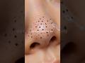 Remove Blackheads &amp; Whiteheads Fast 👃✨Get cleaner pores and smoother-looking skin naturally 💆‍♀️🖤