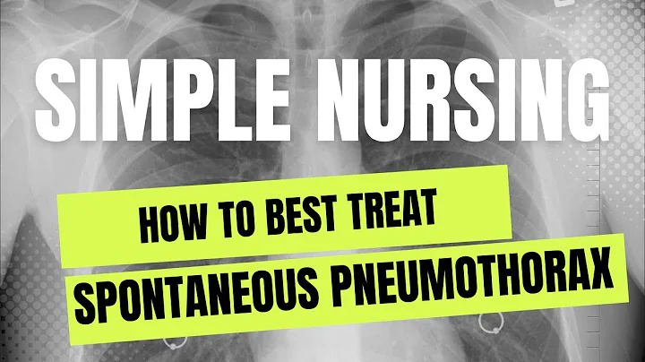 Best Treatment for Spontaneous Pneumothorax
