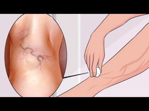 Get Rid of Varicose Veins Forever With The Use of One Simple Ingredient!