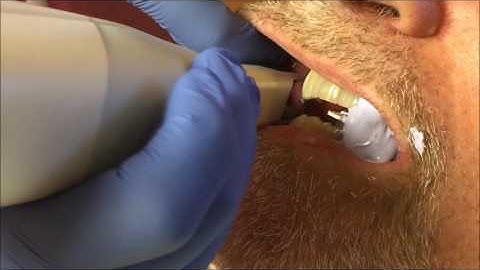 trios scanner bite for sleep impression