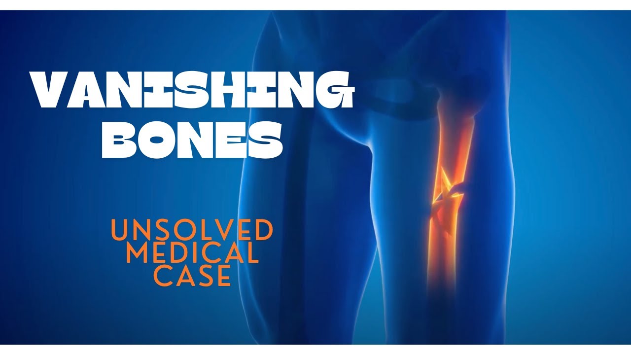 Vanishing Bones - Unsolved Medical Cases
