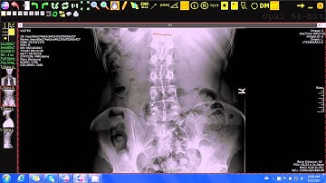 20/20 Imaging Opal-Rad (Chiropractic) Cobb Angle Tool