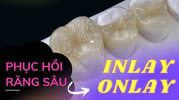 Phục hồi răng vỡ lớn răng sâu với sứ Inlay, Onlay | Tt niềng răng quốc tế Diamond