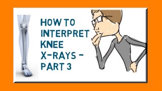 How to interpret knee X-rays - Part 3