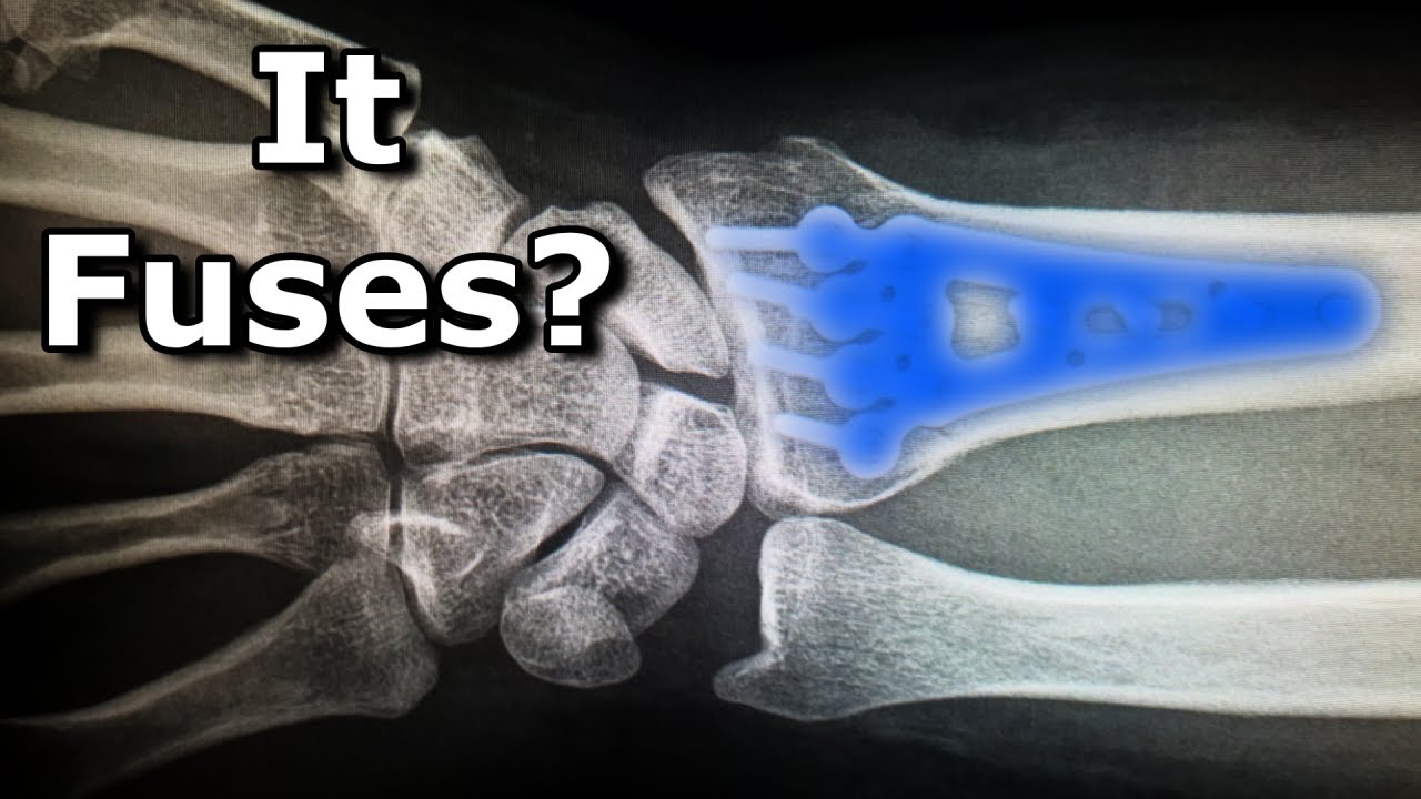 Why Your Body Doesn't Reject Titanium | Meet the Elements - YouTube