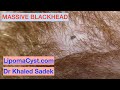 MAASIVE Blackhead. Dr Khaled Sadek. LipomaCyst.com