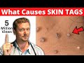 What SKIN TAGS Really Mean  (Does your Doctor know?)