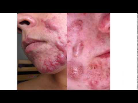 pictures of cystic acne