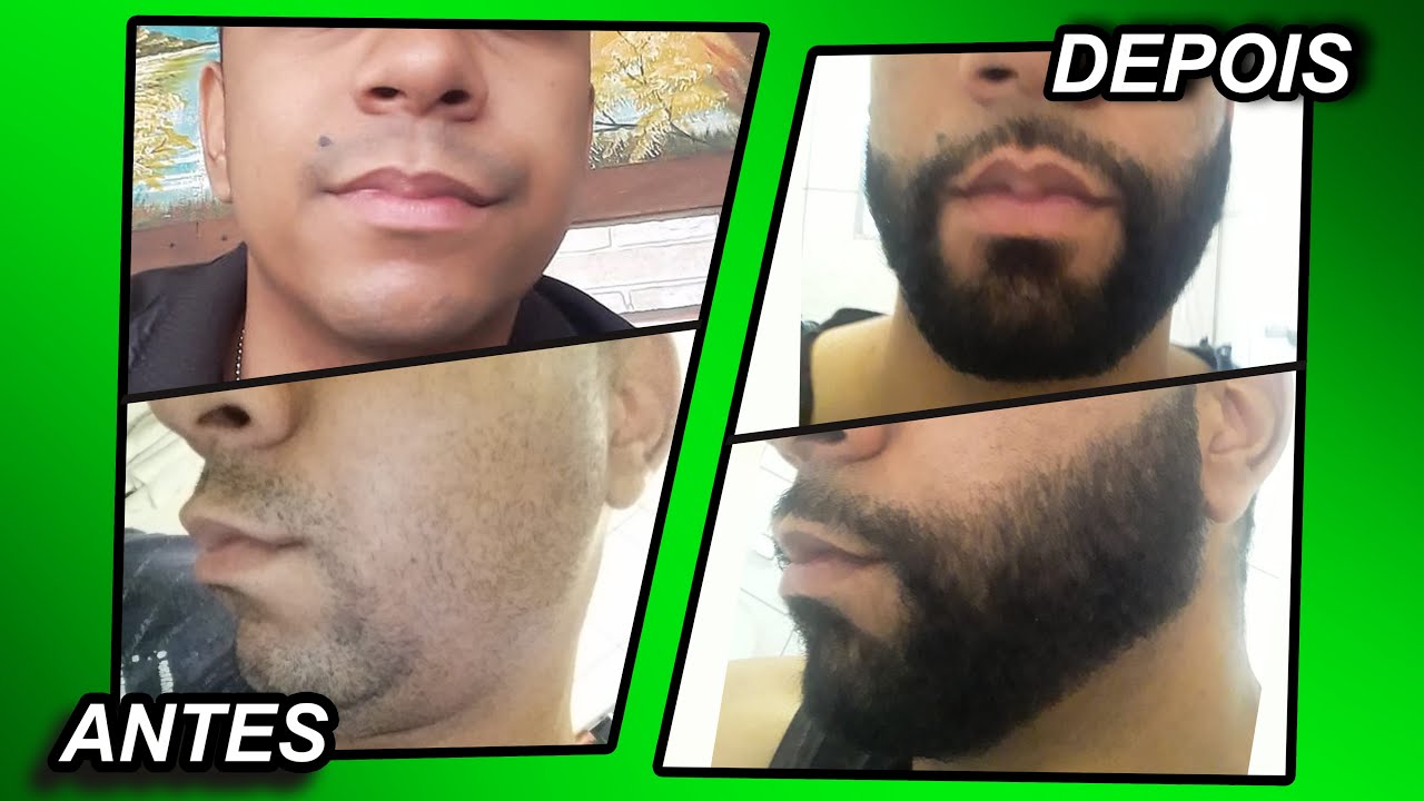 EVOLUÇÃO COM MINOXIDIL - 3 ANOS DE TRATAMENTO (Pant, Foligain e Aloxidil)