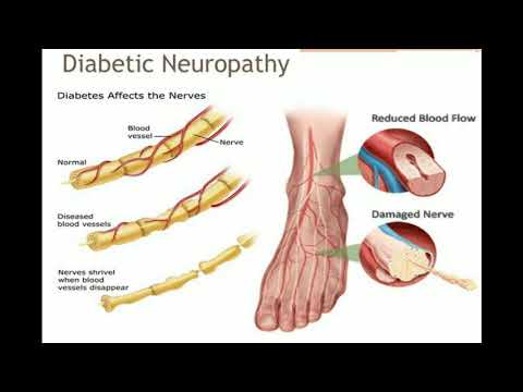 Patofisiologi Neuropati Diabetik