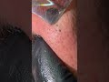Black head removal new #skincare #shoes