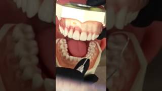 Professor Norrell:  Use of ODU 11/12 explorer on maxillary anteriors