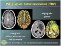 Surgery of Low-Grade Gliomas