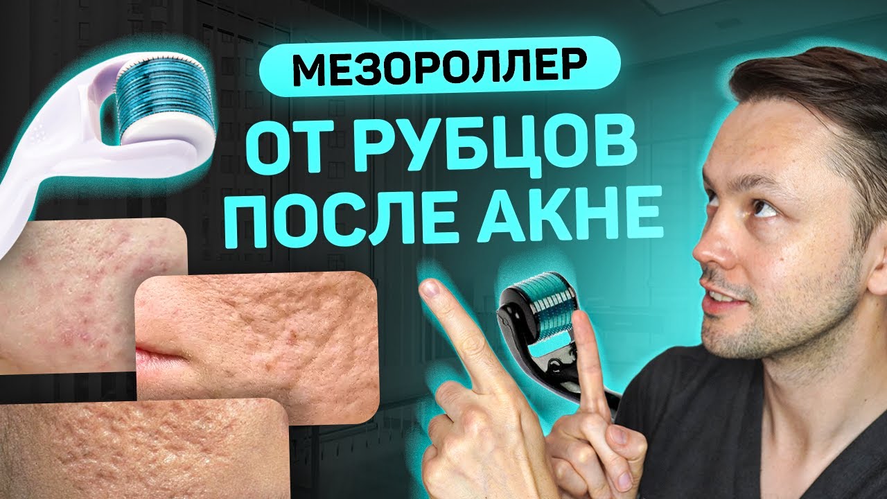 Шрамы после прыщей. Мезороллер от постакне.