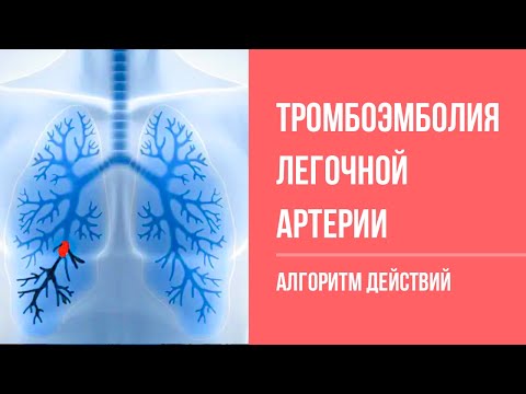 Неотложные состояния: Эмболия легочной артерии