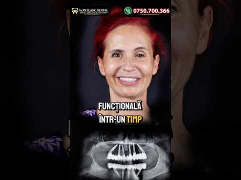 Ce presupune aceasta dantura fixă pe implanturi?