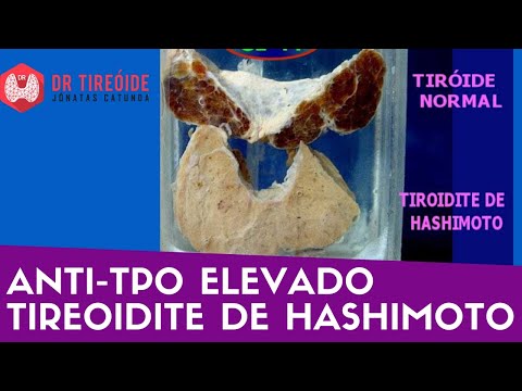 Vídeo: Peroxidase Tireoidiana: Os Anticorpos Estão Elevados - O Que Significa