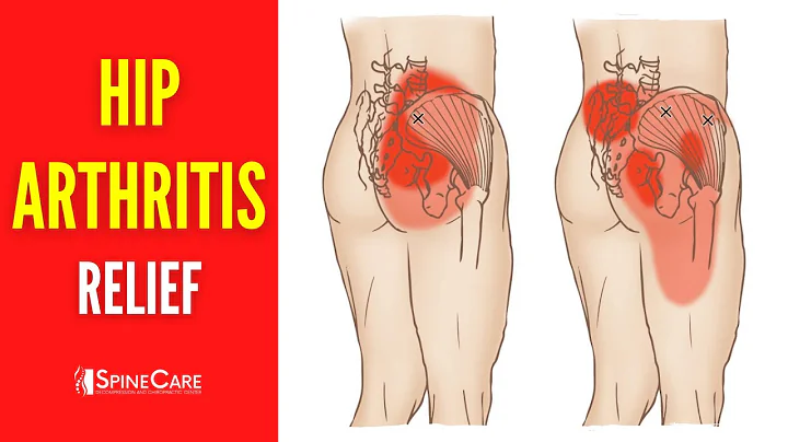 Quick and Effective Hip Arthritis Pain Relief in 30 Seconds!