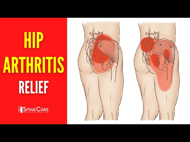 How to Relieve Hip Arthritis Pain in 30 SECONDS 