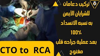 قسطرة تشخيصية وعلاجية للشريان الأيمن مقفول ١٠٠%بعد عمليه جراحة قلب مفتوح ( CTO to RCA after CABG )