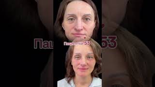 -20 лет после пластики лба, век и носа #ринопластика #фейслифтинг #блефаропластика