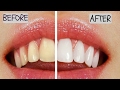 How To Have Natural White Teeth in 3 minutes (works 100%)