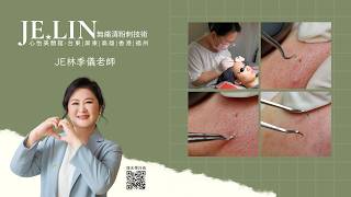 JE臉頰粉刺+太陽穴痘痘 #林季儀老師 #台東心怡美顏館 #無痛清粉刺