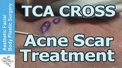 Live Surgery & Discussion with 80% Tricholoroacetic Acid - TCA CROSS for Deep Ice Pick Acne Scars