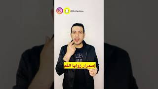 كيفية ازالة السواد والاسمرار حول الفم/ حل نهائى لاسمرار ولسواد حول الفم والشفايف في ايام