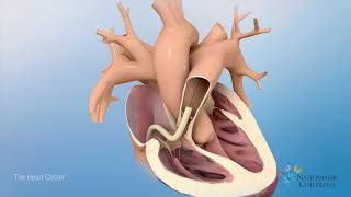 Tetralogy of Fallot (TOF): Animation Explains Heart Defect and Repair
